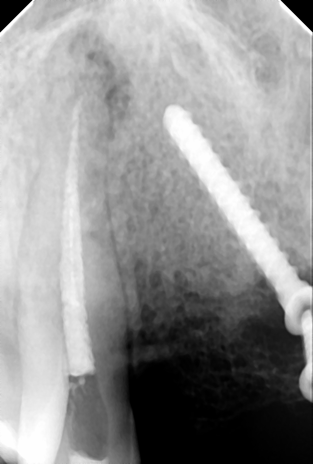 На рентгенограмме визуализируется лечебный материал в корневом канале