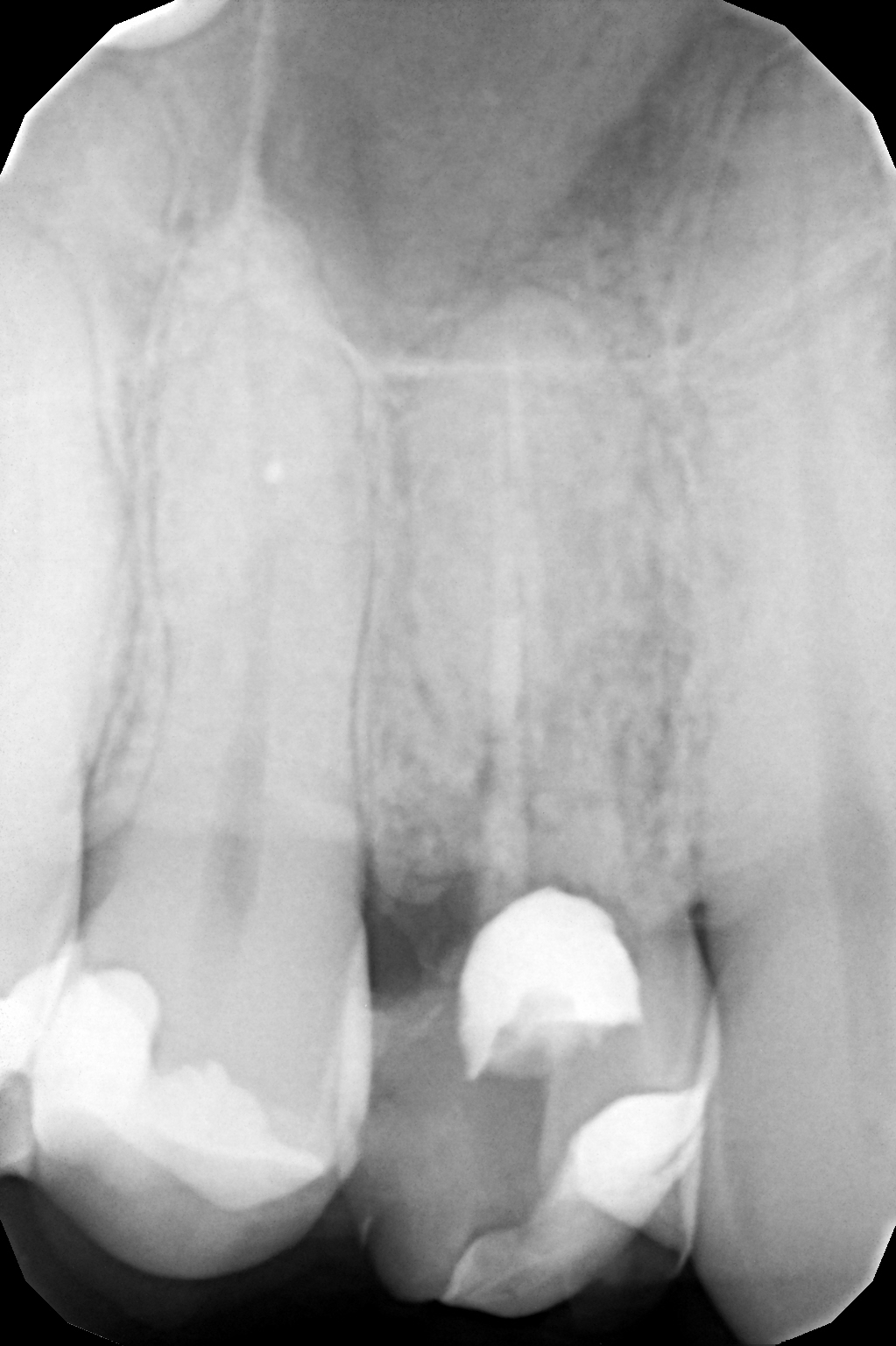 По данным RVG- исследования: распространение кариозного процесса на корень зуба, несостоятельное эндодонтическое лечение корневых каналов, проведенное ранее