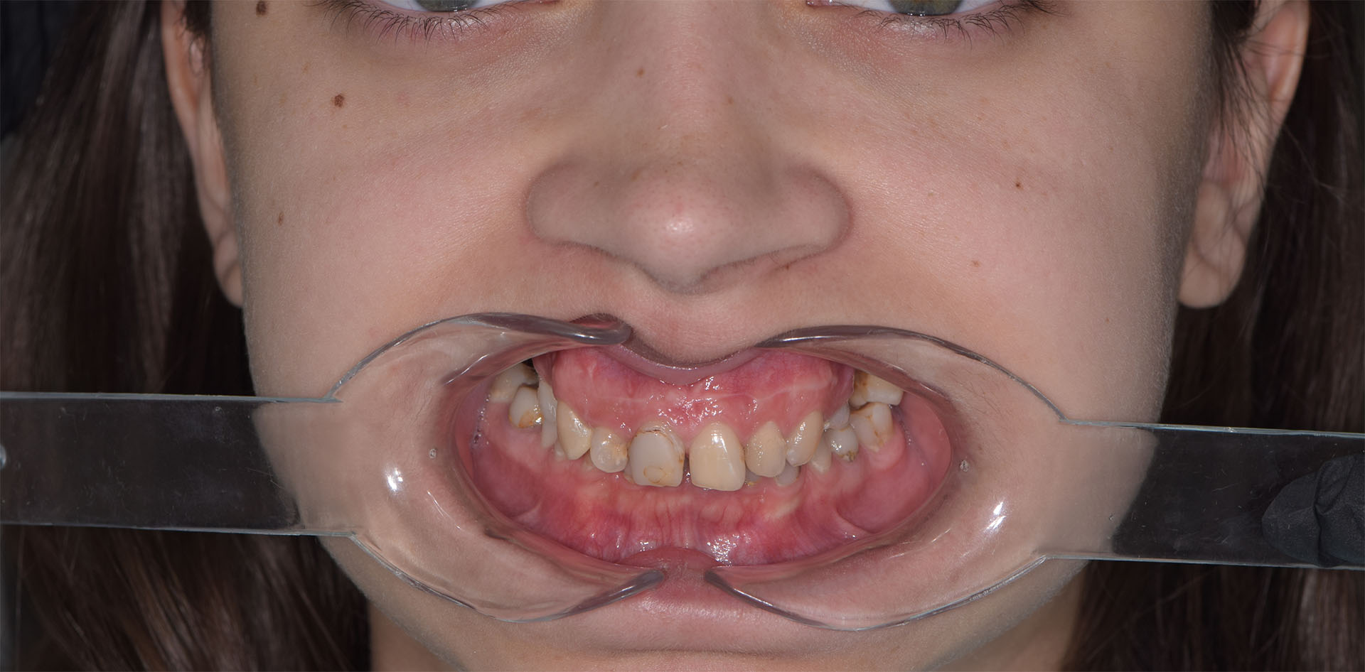 От частичной адентии до идеальной улыбки - Стоматологическая реабилитация в клинике The Dent