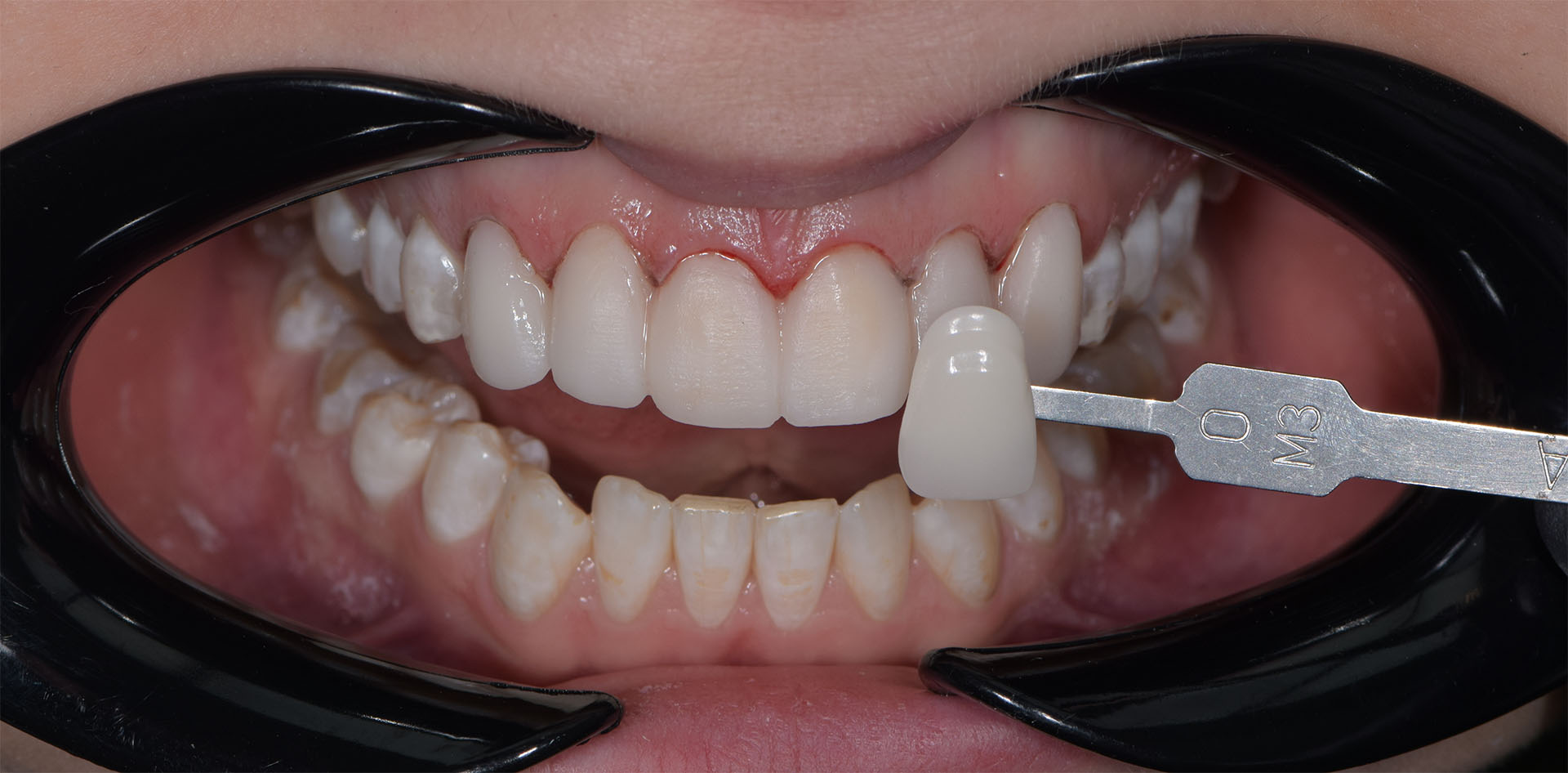 Выбор цвета - Стоматологическая реабилитация в клинике The Dent