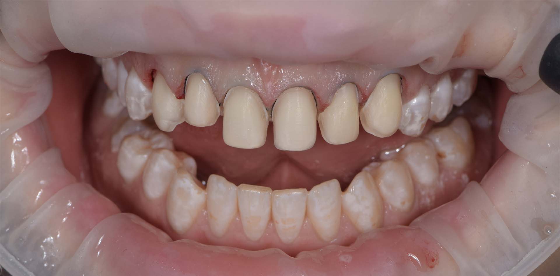 Вид после препарирования - Стоматологическая реабилитация в клинике The Dent