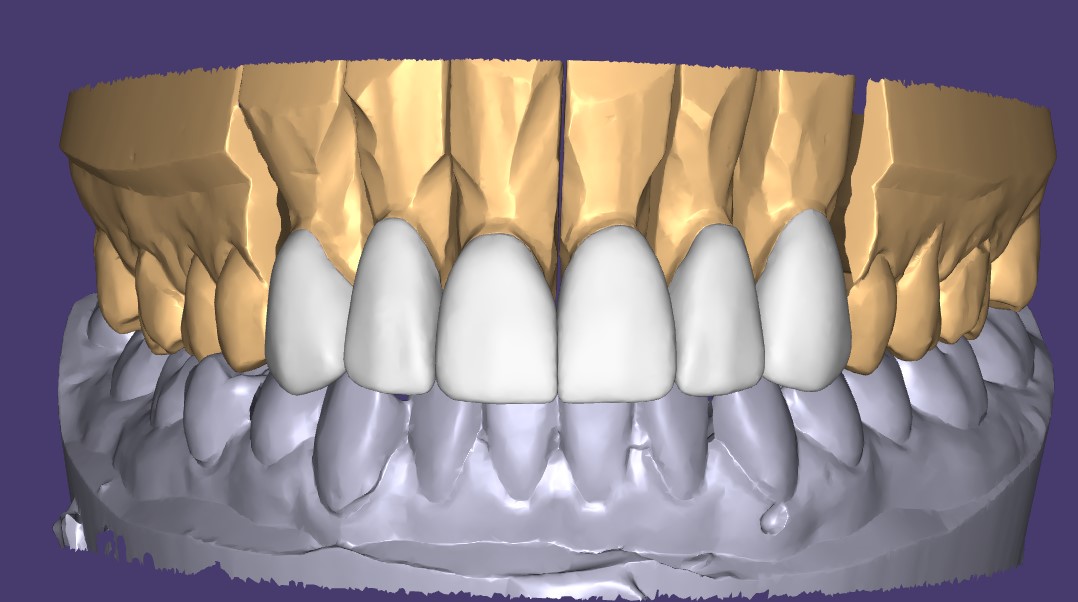 Компьютерное моделирование будущих реставраций - Стоматологическая реабилитация в клинике The Dent