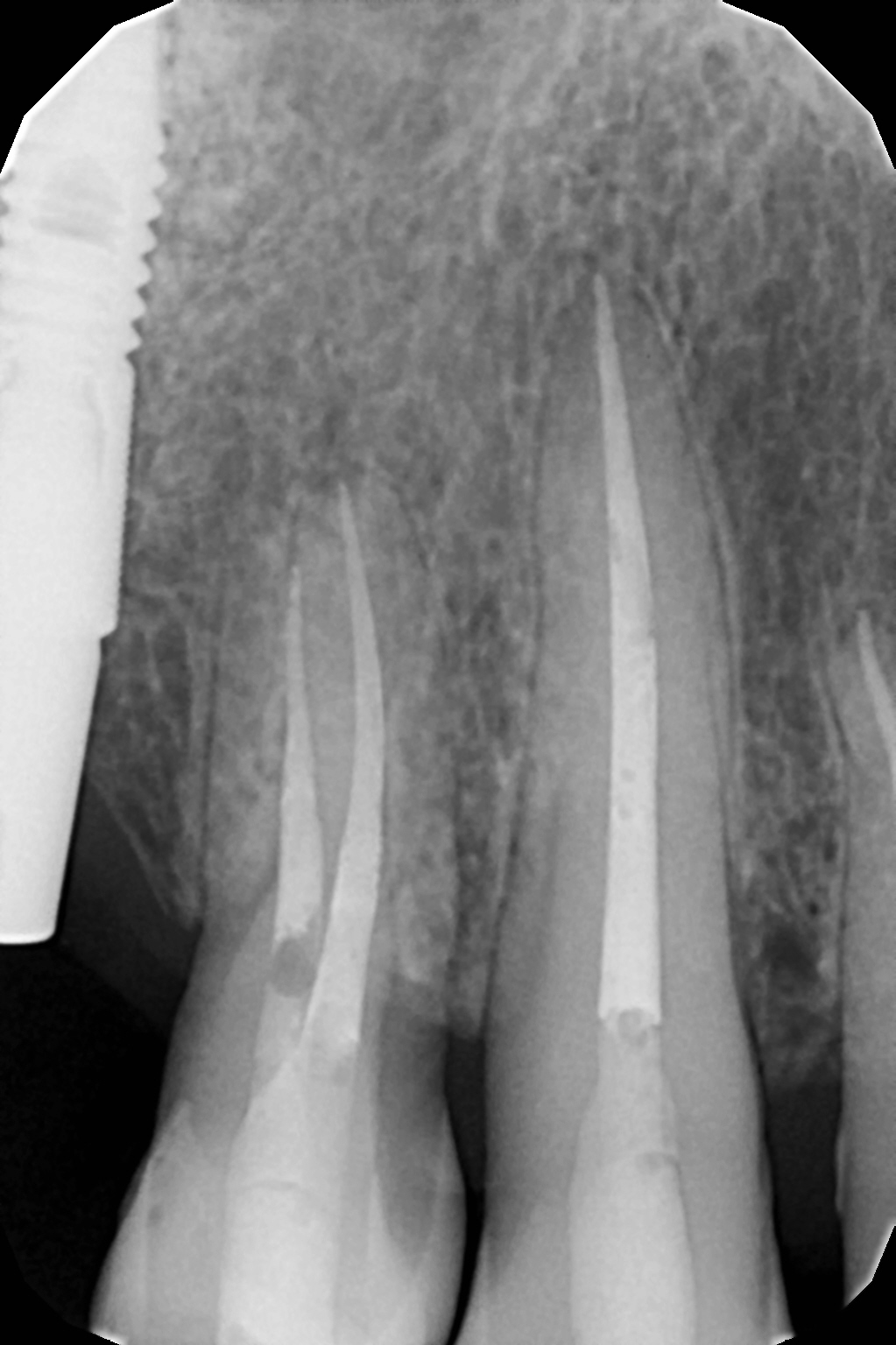Эндодонтическое лечение каналов зубов 1.4-1.3
