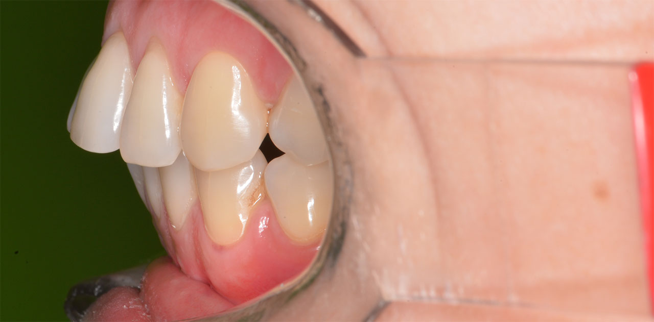 Комбинированный подход к лечению пациента с зубочелюстной аномалией
