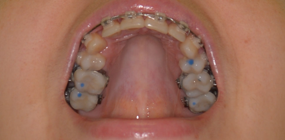 Комбинированный подход к лечению пациента с зубочелюстной аномалией